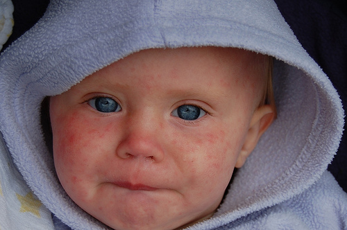 Measles symptoms cure